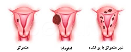 درمان رحم بزرگ