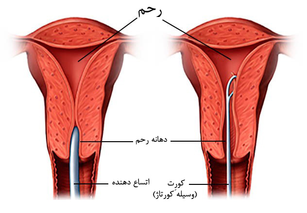 کورتاژ تشخیصی (نمونه برداری رحم)