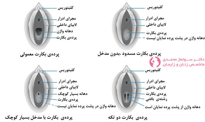 انواع پرده بکارت