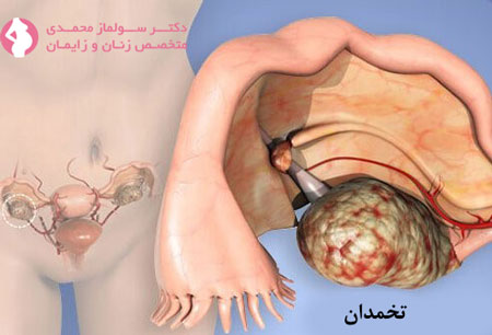 علائم سرطان تخمدان
