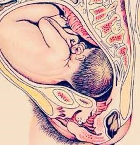 چسبندگی جفت چگونه تشخیص داده می شود؟