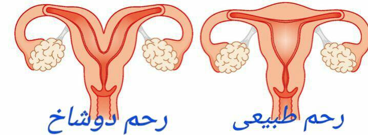 رحم دوشاخ