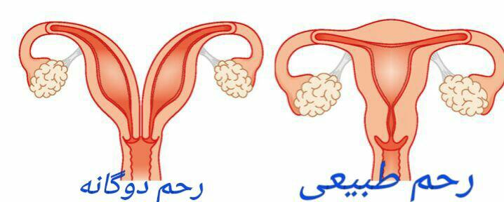 رحم دوگانه