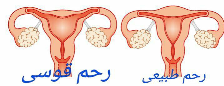رحم قوسی