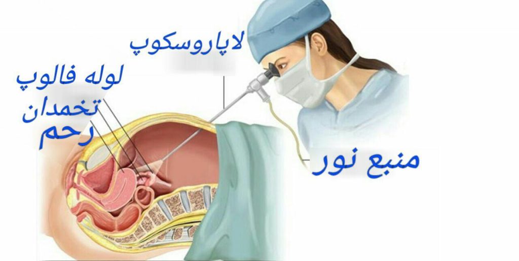 لاپاروسکوپی