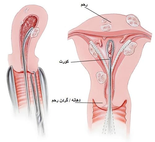 روش درمانی دیلاسیون و کورتاژ برای بیماری زنان