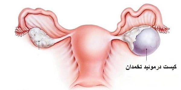 کیست درموئید تخمدان