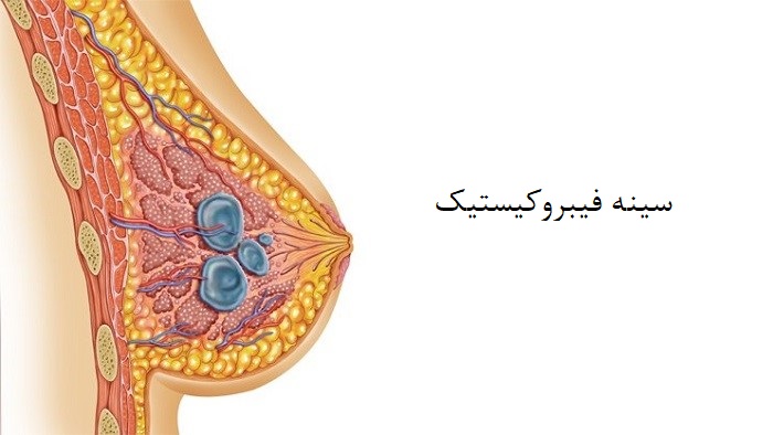 سینه فیبروکیستیک